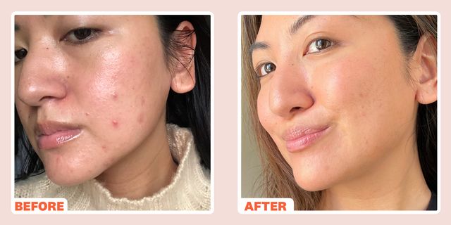 Microneedling & Acne Scars | Glow Bright Med Spa