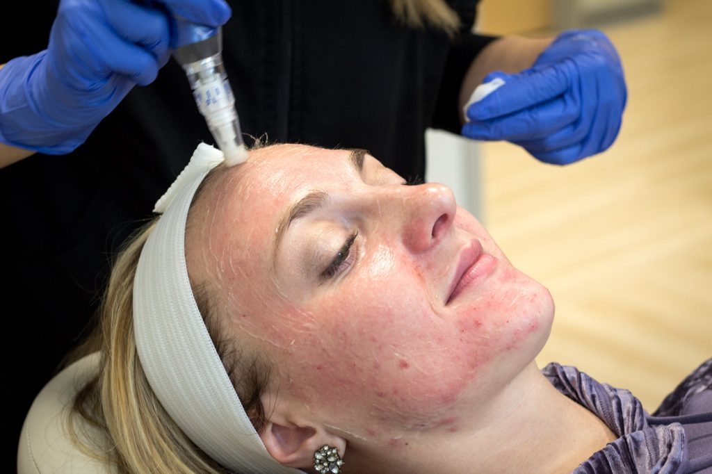 Microneedling For Acne Scars | Glow Bright Med Spa