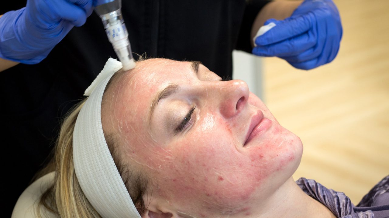 Microneedling For Acne Scars | Glow Bright Med Spa